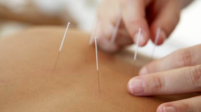 Understanding myofascial trigger points, neuromuscular therapy & dry needling