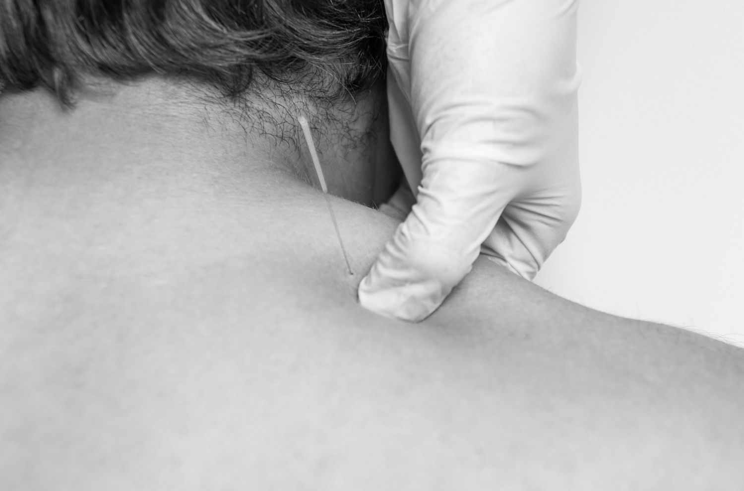 Connective tissue and scar tissue dry needling